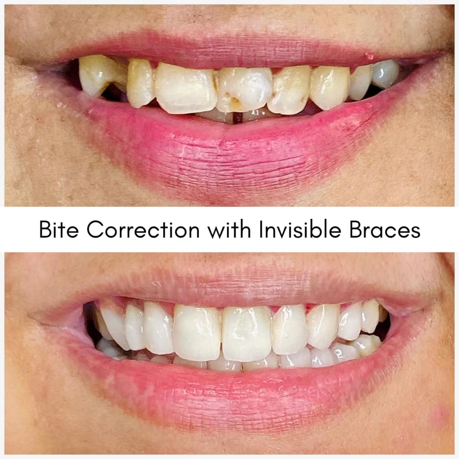 Bite Correction with Invisible Braces, smile makeover case at i-Smile Dental Clinic