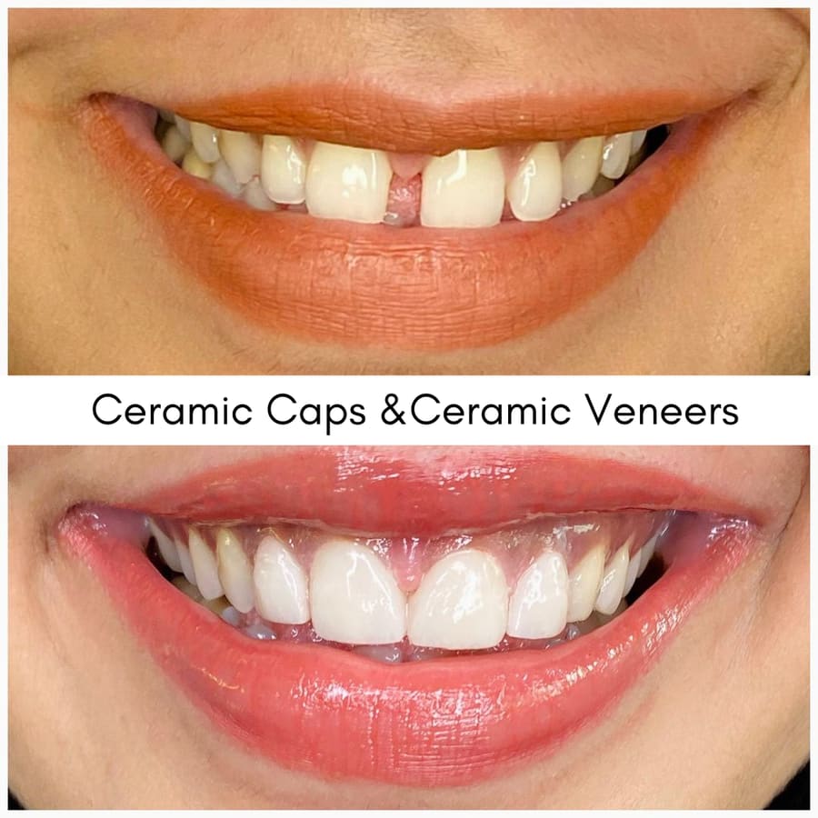 Ceramic Caps & Ceramic Veneers, smile makeover case at i-Smile Dental Clinic