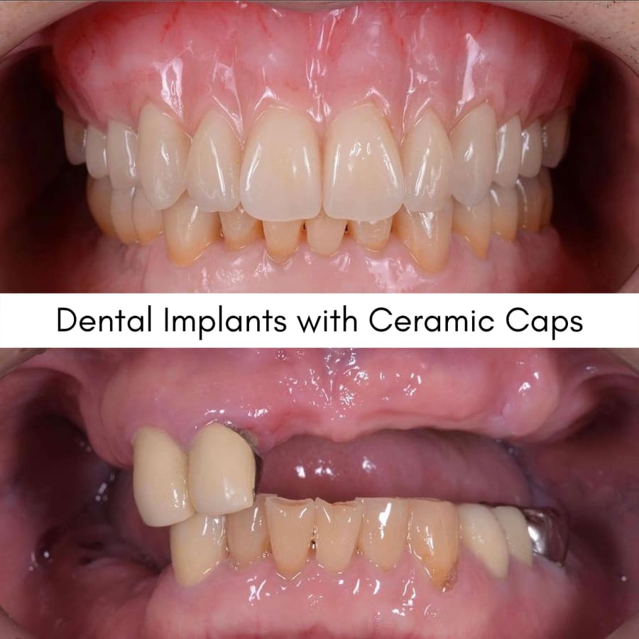 Dental Implants with Ceramic Caps, smile makeover case at i-Smile Dental Clinic