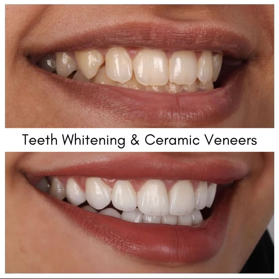 Teeth Whitening & Ceramic Veneers, smile makeover case at i-Smile Dental Clinic