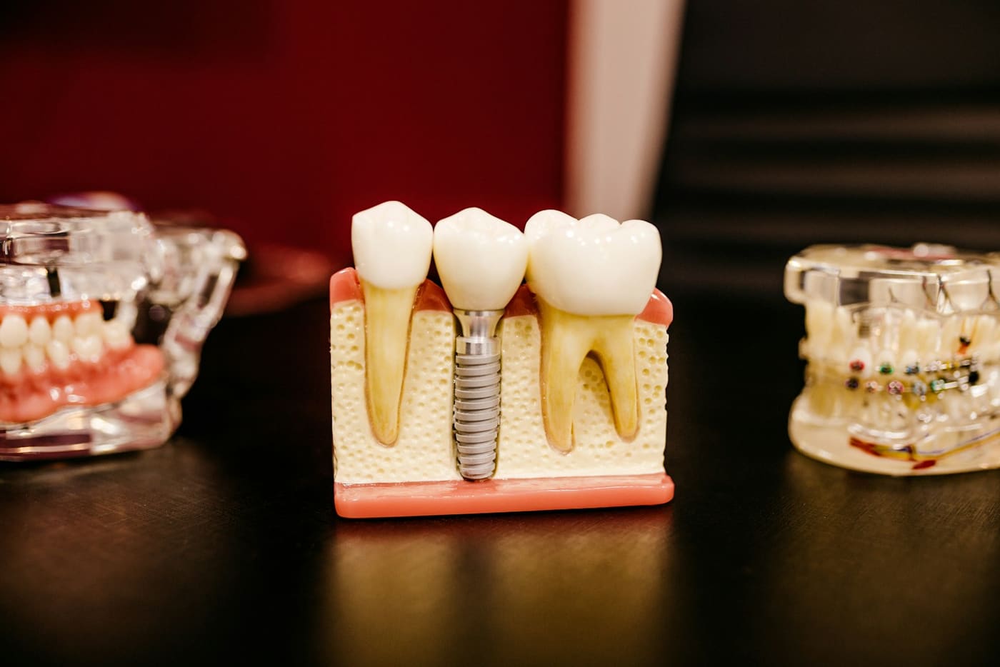 Dental model showing natural teeth beside an implant with a crown